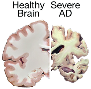 Alzheimer's disease 