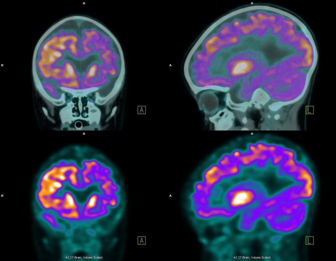 PET (positron emission tomography) scan of the brain