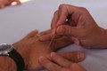 Person having acupuncture on hands, close-up