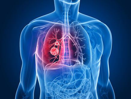 ilustration of lung cancer